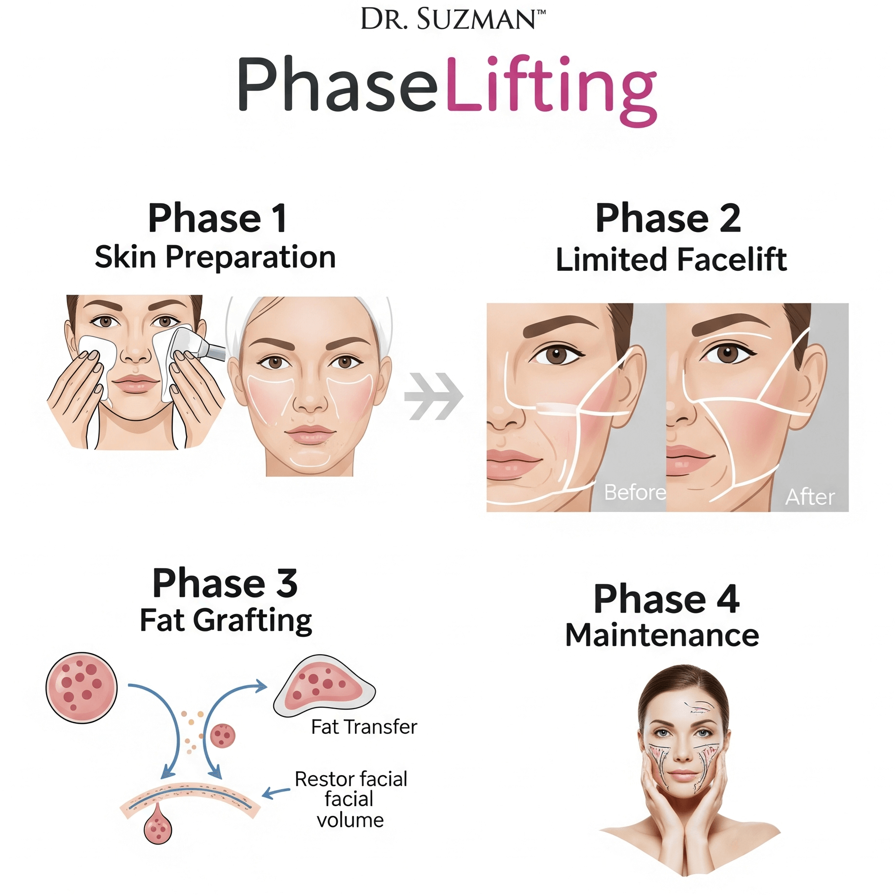Dr Suzman Facelift